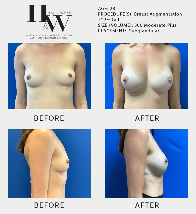 Breast augmentation, Breast enlargement, What an enlarged chest looks like