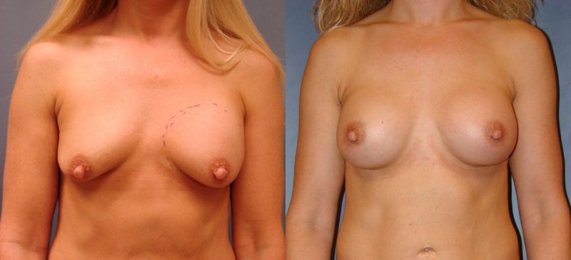 Breast augmentation, Breast implant, Breast plastic