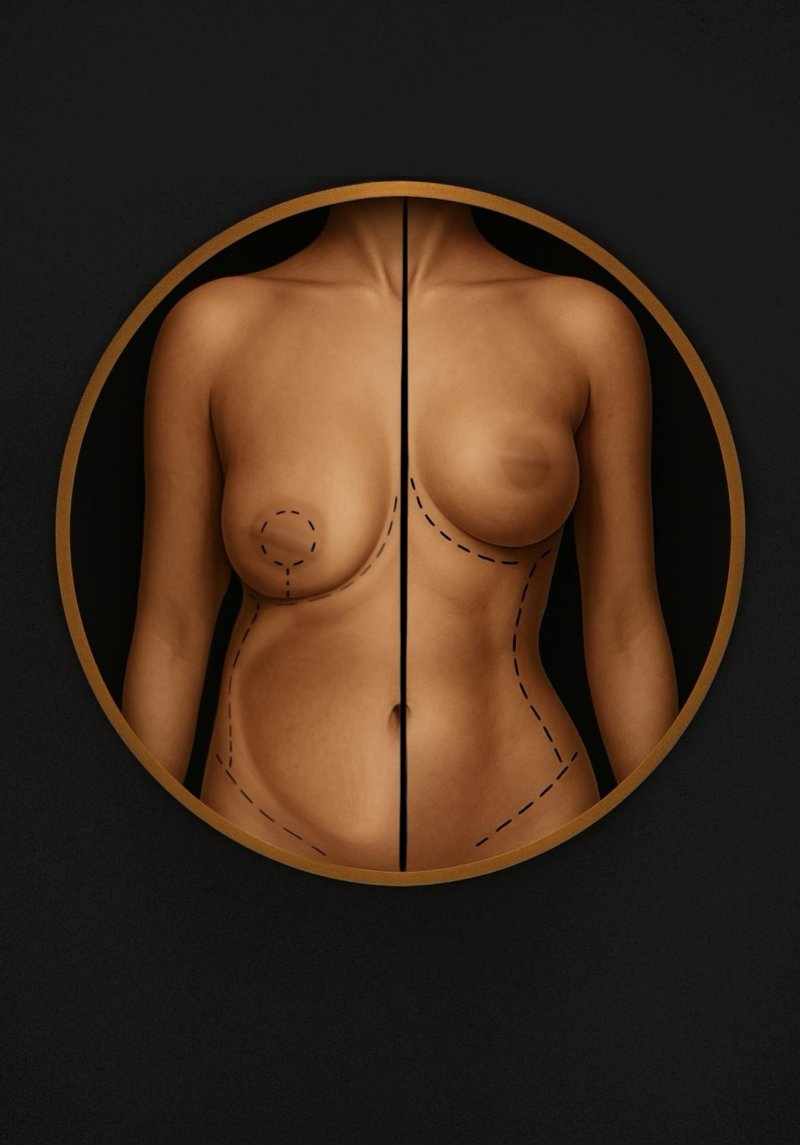 Breast plastic, Breast, Breast enlargement
