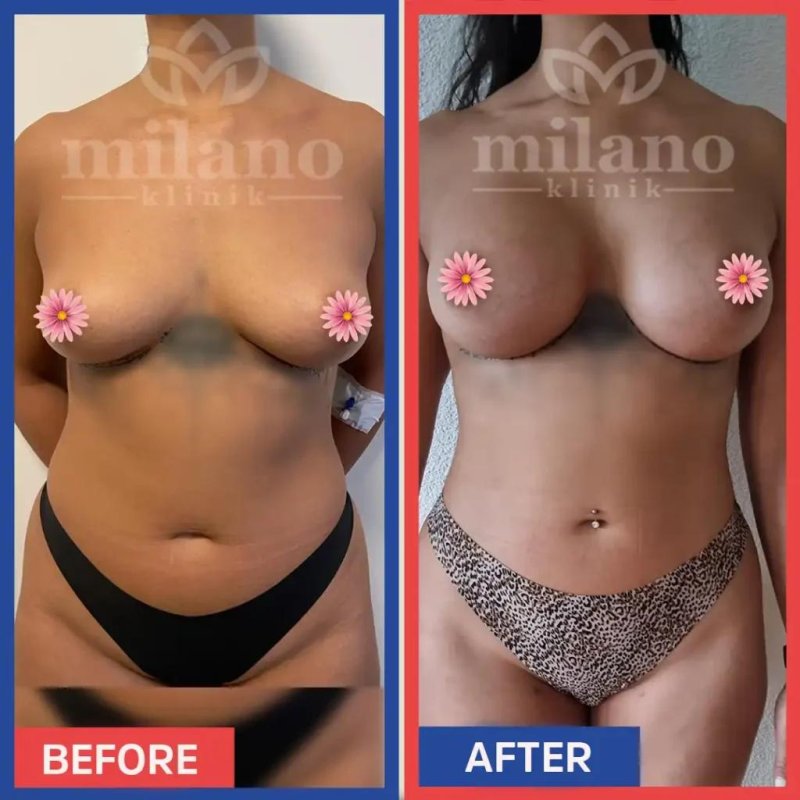 Breast enlargement, Breast augmentation, Breast plastic