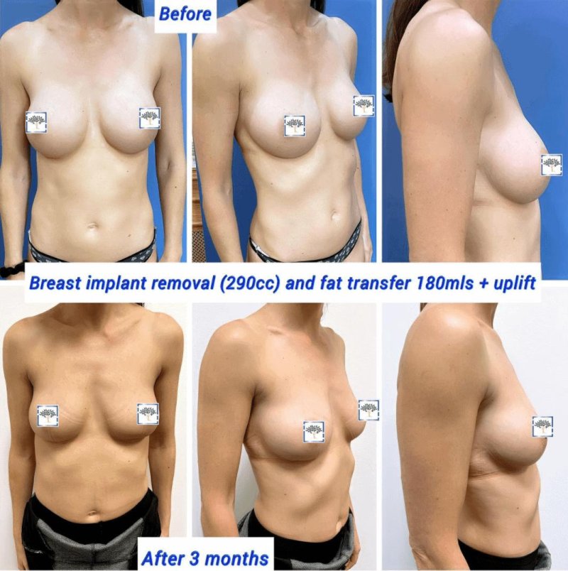 Breast implant, Breast augmentation, For breast augmentation